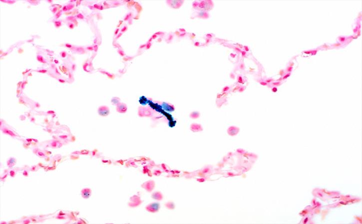 Asbestosis